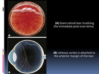 (A) Giant retinal tear involving
the immediate post-oral retina;
(B) vitreous cortex is attached to
the anterior margin of the tear
 