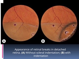 Appearance of retinal breaks in detached
retina. (A) Without scleral indentation; (B) with
indentation
 