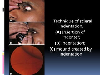 Technique of scleral
indentation.
(A) Insertion of
indenter;
(B) indentation;
(C) mound created by
indentation
 
