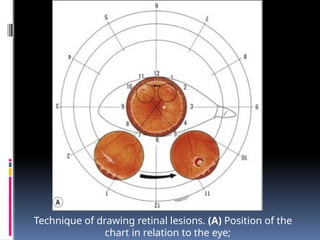 Technique of drawing retinal lesions. (A) Position of the
chart in relation to the eye;
 
