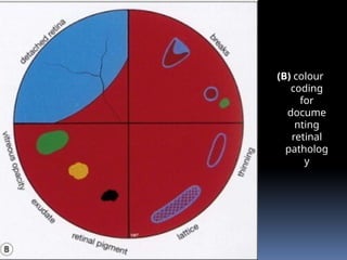 (B) colour
coding
for
docume
nting
retinal
patholog
y
 