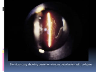 Biomicroscopy showing posterior vitreous detachment with collapse
 