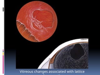 Vitreous changes associated with lattice
 