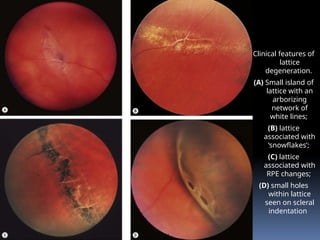 Clinical features of
lattice
degeneration.
(A) Small island of
lattice with an
arborizing
network of
white lines;
(B) lattice
associated with
‘snowflakes’;
(C) lattice
associated with
RPE changes;
(D) small holes
within lattice
seen on scleral
indentation
 