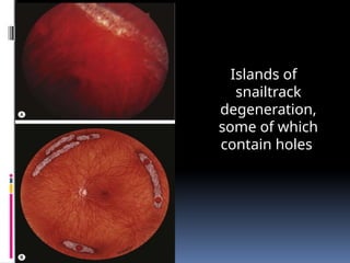 Islands of
snailtrack
degeneration,
some of which
contain holes
 