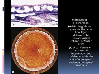 Microcystoid
degeneration.
(A) Histology shows
spaces in the nerve
fibre layer
delineated by
delicate vertical
columns of Müller
cells;
(B) circumferential
microcystoid
degeneration and
mild retinoschisis in
the inferotemporal
and superotemporal
quadrants
 