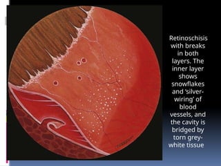 Retinoschisis
with breaks
in both
layers. The
inner layer
shows
snowflakes
and ‘silver-
wiring’ of
blood
vessels, and
the cavity is
bridged by
torn grey-
white tissue
 