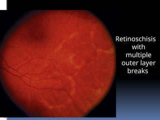 Retinoschisis
with
multiple
outer layer
breaks
 