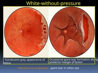 White-without-pressure
Indications for prophylaxis - giant tear in other eye
Translucent grey appearance of
retina
Occasional giant tear formation along
posterior margin of lesion
 