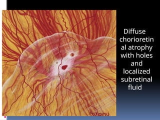 Diffuse
chorioretin
al atrophy
with holes
and
localized
subretinal
fluid
 