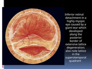 Inferior retinal
detachment in a
highly myopic
eye caused by a
giant tear which
developed
along the
posterior
border of
extensive lattice
degeneration;
also note lattice
in the
superotemporal
quadrant
 