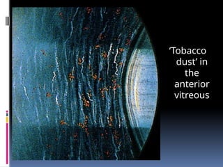 ‘Tobacco
dust’ in
the
anterior
vitreous
 