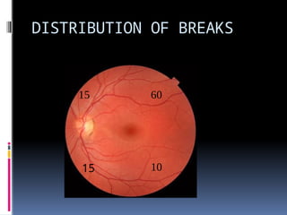 DISTRIBUTION OF BREAKS
15
60
10
15
15
 