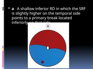  a A shallow inferior RD in which the SRF
is slightly higher on the temporal side
points to a primary break located
inferiorly on that side.
 