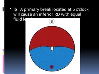  b A primary break located at 6 o’clock
will cause an inferior RD with equal
fluid levels.
 
