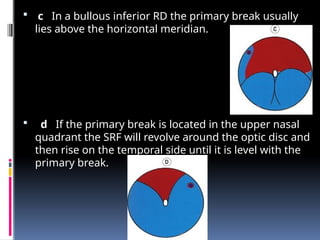  c In a bullous inferior RD the primary break usually
lies above the horizontal meridian.
 d If the primary break is located in the upper nasal
quadrant the SRF will revolve around the optic disc and
then rise on the temporal side until it is level with the
primary break.
 