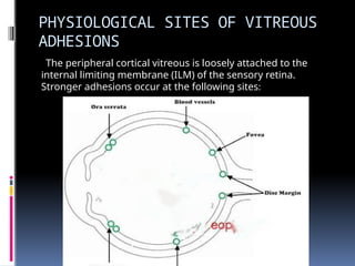 PHYSIOLOGICAL SITES OF VITREOUS
ADHESIONS
The peripheral cortical vitreous is loosely attached to the
internal limiting membrane (ILM) of the sensory retina.
Stronger adhesions occur at the following sites:
 