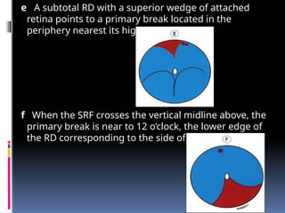 e A subtotal RD with a superior wedge of attached
retina points to a primary break located in the
periphery nearest its highest border.
f When the SRF crosses the vertical midline above, the
primary break is near to 12 o’clock, the lower edge of
the RD corresponding to the side of the break .
 