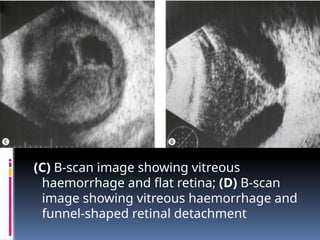 (C) B-scan image showing vitreous
haemorrhage and flat retina; (D) B-scan
image showing vitreous haemorrhage and
funnel-shaped retinal detachment
 