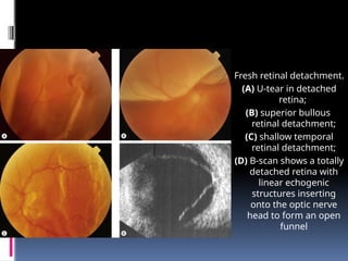 Fresh retinal detachment.
(A) U-tear in detached
retina;
(B) superior bullous
retinal detachment;
(C) shallow temporal
retinal detachment;
(D) B-scan shows a totally
detached retina with
linear echogenic
structures inserting
onto the optic nerve
head to form an open
funnel
 