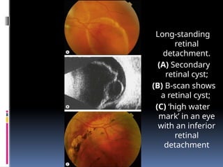 Long-standing
retinal
detachment.
(A) Secondary
retinal cyst;
(B) B-scan shows
a retinal cyst;
(C) ‘high water
mark’ in an eye
with an inferior
retinal
detachment
 