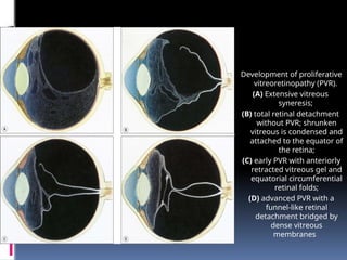 Development of proliferative
vitreoretinopathy (PVR).
(A) Extensive vitreous
syneresis;
(B) total retinal detachment
without PVR; shrunken
vitreous is condensed and
attached to the equator of
the retina;
(C) early PVR with anteriorly
retracted vitreous gel and
equatorial circumferential
retinal folds;
(D) advanced PVR with a
funnel-like retinal
detachment bridged by
dense vitreous
membranes
 