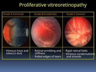 Proliferative vitreoretinopathy
• Vitreous haze and
tobacco dust
Grade A (minimal)
• Rigid retinal folds
• Vitreous condensations
and strands
Grade C (severe)
• Retinal wrinkling and
stiffness
• Rolled edges of tears
Grade B (moderate)
 