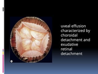 uveal effusion
characterized by
choroidal
detachment and
exudative
retinal
detachment
 