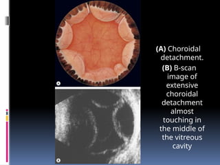 (A) Choroidal
detachment.
(B) B-scan
image of
extensive
choroidal
detachment
almost
touching in
the middle of
the vitreous
cavity
 