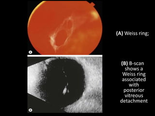(A) Weiss ring;
(B) B-scan
shows a
Weiss ring
associated
with
posterior
vitreous
detachment
 