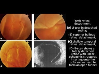 Fresh retinal
detachment.
(A) U-tear in detached
retina;
(B) superior bullous
retinal detachment;
(C) shallow temporal
retinal detachment;
(D) B-scan shows a
totally detached
retina with linear
echogenic structures
inserting onto the
optic nerve head to
form an open funnel
 