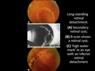Long-standing
retinal
detachment.
(A) Secondary
retinal cyst;
(B) B-scan shows
a retinal cyst;
(C) ‘high water
mark’ in an eye
with an inferior
retinal
detachment
 