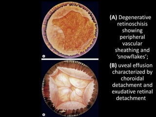 (A) Degenerative
retinoschisis
showing
peripheral
vascular
sheathing and
‘snowflakes’;
(B) uveal effusion
characterized by
choroidal
detachment and
exudative retinal
detachment
 