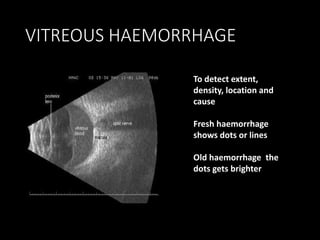 VITREOUS HAEMORRHAGE
To detect extent,
density, location and
cause
Fresh haemorrhage
shows dots or lines
Old haemorrhage the
dots gets brighter
 