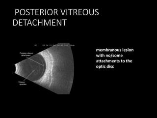 POSTERIOR VITREOUS
DETACHMENT
membranous lesion
with no/some
attachments to the
optic disc
 