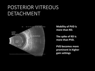 POSTERIOR VITREOUS
DETACHMENT
Mobility of PVD is
more than RD.
The spike of RD is
more than PVD.
PVD becomes more
prominent in higher
gain settings
 