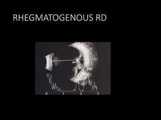 RHEGMATOGENOUS RD
 