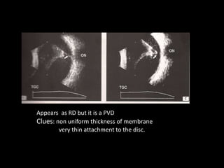 Appears as RD but it is a PVD
Clues: non uniform thickness of membrane
very thin attachment to the disc.
 