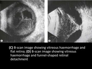 (C) B-scan image showing vitreous haemorrhage and
flat retina; (D) B-scan image showing vitreous
haemorrhage and funnel-shaped retinal
detachment
 