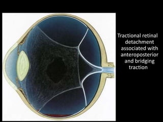 Tractional retinal
detachment
associated with
anteroposterior
and bridging
traction
 