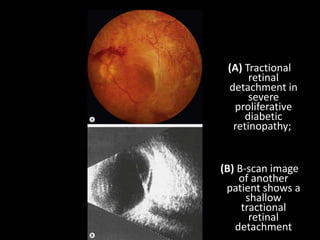 (A) Tractional
retinal
detachment in
severe
proliferative
diabetic
retinopathy;
(B) B-scan image
of another
patient shows a
shallow
tractional
retinal
detachment
 