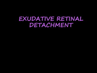 EXUDATIVE RETINAL
DETACHMENT
 