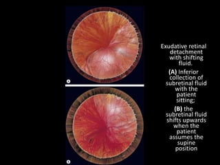 Exudative retinal
detachment
with shifting
fluid.
(A) Inferior
collection of
subretinal fluid
with the
patient
sitting;
(B) the
subretinal fluid
shifts upwards
when the
patient
assumes the
supine
position
 