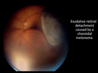 Exudative retinal
detachment
caused by a
choroidal
melanoma
 