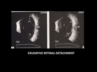 EXUDATIVE RETINAL DETACHMENT
 