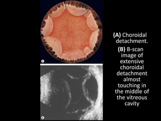 (A) Choroidal
detachment.
(B) B-scan
image of
extensive
choroidal
detachment
almost
touching in
the middle of
the vitreous
cavity
 