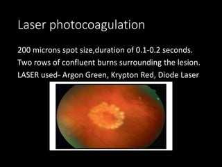 Laser photocoagulation
200 microns spot size,duration of 0.1-0.2 seconds.
Two rows of confluent burns surrounding the lesion.
LASER used- Argon Green, Krypton Red, Diode Laser
 
