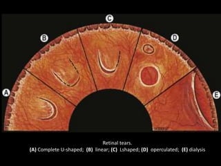 Retinal tears.
(A) Complete U-shaped; (B) linear; (C) Lshaped; (D) operculated; (E) dialysis
 