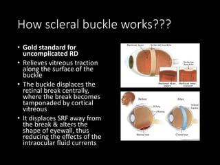 How scleral buckle works???
• Gold standard for
uncomplicated RD
• Relieves vitreous traction
along the surface of the
buckle
• The buckle displaces the
retinal break centrally,
where the break becomes
tamponaded by cortical
vitreous
• It displaces SRF away from
the break & alters the
shape of eyewall, thus
reducing the effects of the
intraocular fluid currents
 