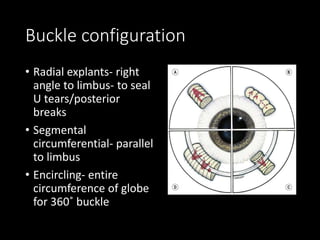 Buckle configuration
• Radial explants- right
angle to limbus- to seal
U tears/posterior
breaks
• Segmental
circumferential- parallel
to limbus
• Encircling- entire
circumference of globe
for 360˚ buckle
 